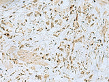 Immunohistochemistry of paraffin-embedded Human gastric cancer tissue using HOXC9 Polyclonal Antibody at dilution of 1:40(×200)