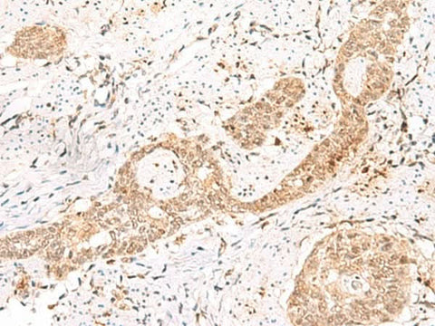 Immunohistochemistry of paraffin-embedded Human esophagus cancer tissue using PRKAG2 Polyclonal Antibody at dilution of 1:55(×200)