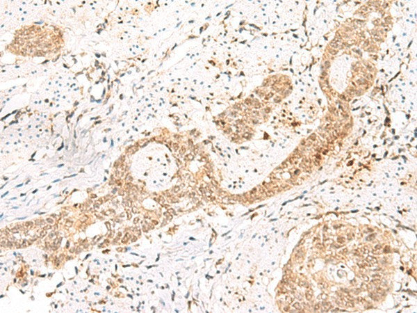 Immunohistochemistry of paraffin-embedded Human esophagus cancer tissue using PRKAG2 Polyclonal Antibody at dilution of 1:55(×200)