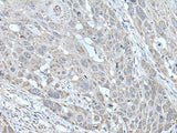 Immunohistochemistry of paraffin-embedded Human esophagus cancer tissue using SCNN1G Polyclonal Antibody at dilution of 1:40(×200)