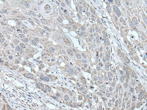 Immunohistochemistry of paraffin-embedded Human esophagus cancer tissue using SCNN1G Polyclonal Antibody at dilution of 1:40(×200)