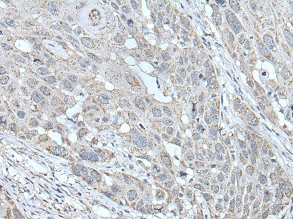 Immunohistochemistry of paraffin-embedded Human esophagus cancer tissue using SCNN1G Polyclonal Antibody at dilution of 1:40(×200)