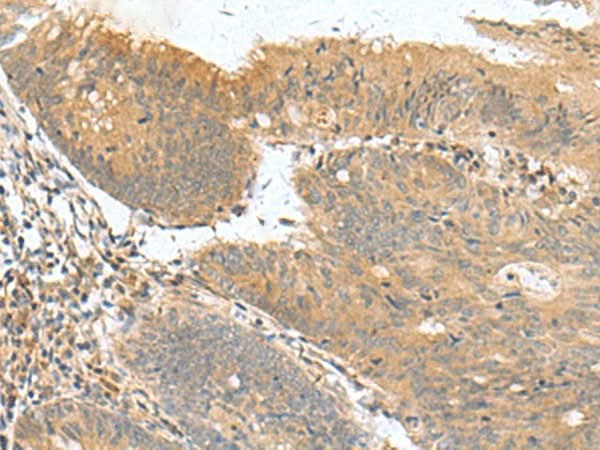 Immunohistochemistry of paraffin-embedded Human colorectal cancer tissue using HHIPL2 Polyclonal Antibody at dilution of 1:50(×200)