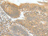 Immunohistochemistry of paraffin-embedded Human colorectal cancer tissue using HHIPL2 Polyclonal Antibody at dilution of 1:50(×200)