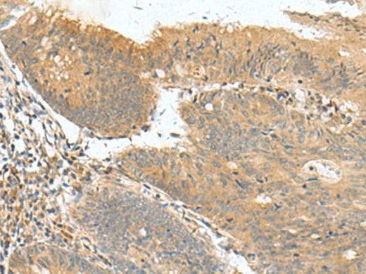 Immunohistochemistry of paraffin-embedded Human colorectal cancer tissue using HHIPL2 Polyclonal Antibody at dilution of 1:50(×200)