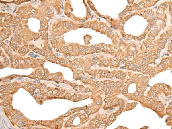 Immunohistochemistry of paraffin-embedded Human thyroid cancer tissue using CUTA Polyclonal Antibody at dilution of 1:45(×200)