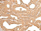 Immunohistochemistry of paraffin-embedded Human thyroid cancer tissue using CUTA Polyclonal Antibody at dilution of 1:45(×200)