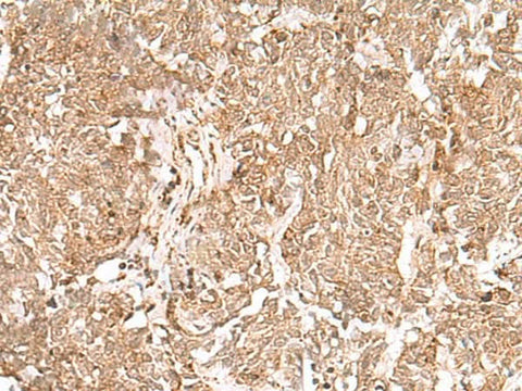Immunohistochemistry of paraffin-embedded Human lung cancer tissue using GMPPB Polyclonal Antibody at dilution of 1:50(×200)