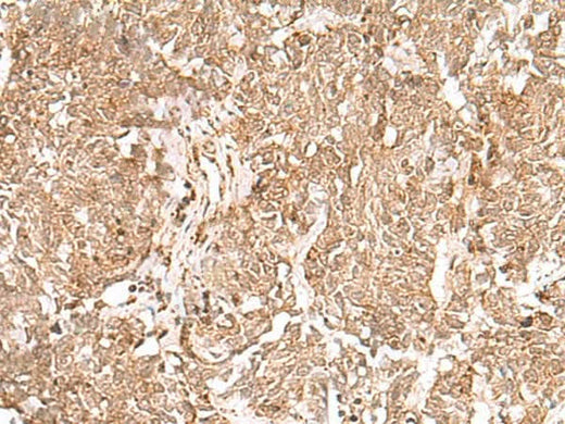Immunohistochemistry of paraffin-embedded Human lung cancer tissue using GMPPB Polyclonal Antibody at dilution of 1:50(×200)