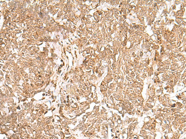 Immunohistochemistry of paraffin-embedded Human lung cancer tissue using GMPPB Polyclonal Antibody at dilution of 1:50(×200)