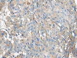 Immunohistochemistry of paraffin-embedded Human liver cancer tissue using KIAA0556 Polyclonal Antibody at dilution of 1:90(×200)