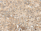 Immunohistochemistry of paraffin-embedded Human cervical cancer tissue using GFI1 Polyclonal Antibody at dilution of 1:60(×200)