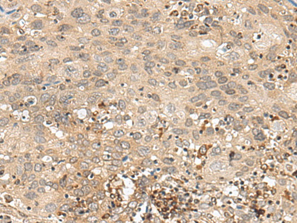Immunohistochemistry of paraffin-embedded Human cervical cancer tissue using GFI1 Polyclonal Antibody at dilution of 1:60(×200)