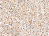 Immunohistochemistry of paraffin-embedded Human liver cancer tissue using HLA-E Polyclonal Antibody at dilution of 1:50(×200)