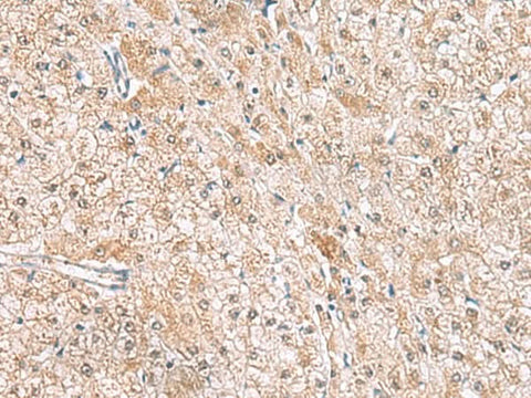 Immunohistochemistry of paraffin-embedded Human liver cancer tissue using HLA-E Polyclonal Antibody at dilution of 1:50(×200)
