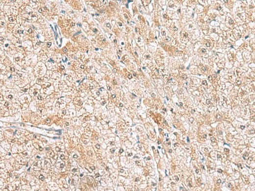 Immunohistochemistry of paraffin-embedded Human liver cancer tissue using HLA-E Polyclonal Antibody at dilution of 1:50(×200)