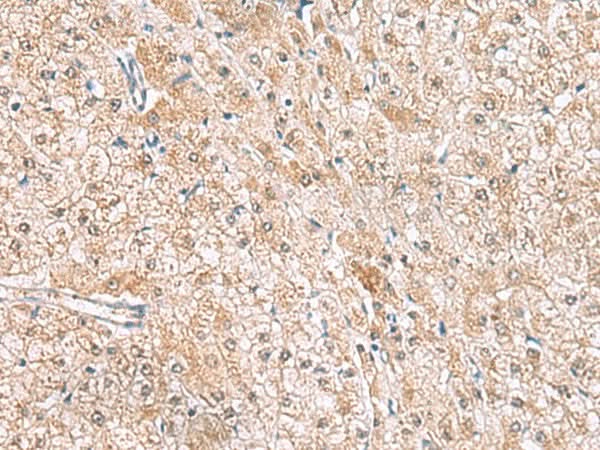 Immunohistochemistry of paraffin-embedded Human liver cancer tissue using HLA-E Polyclonal Antibody at dilution of 1:50(×200)