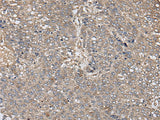 Immunohistochemistry of paraffin-embedded Human liver cancer tissue using ZFP36 Polyclonal Antibody at dilution of 1:40(×200)