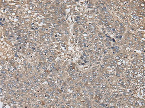 Immunohistochemistry of paraffin-embedded Human liver cancer tissue using ZFP36 Polyclonal Antibody at dilution of 1:40(×200)