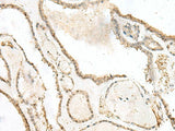 Immunohistochemistry of paraffin-embedded Human thyroid cancer tissue using LIG4 Polyclonal Antibody at dilution of 1:40(×200)