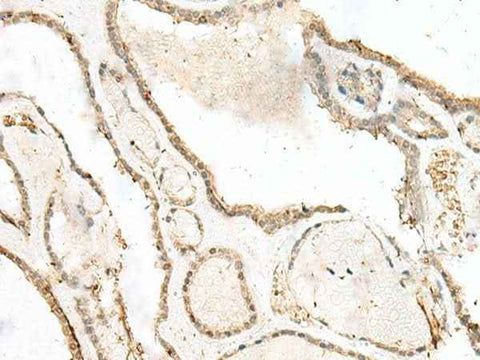 Immunohistochemistry of paraffin-embedded Human thyroid cancer tissue using LIG4 Polyclonal Antibody at dilution of 1:40(×200)
