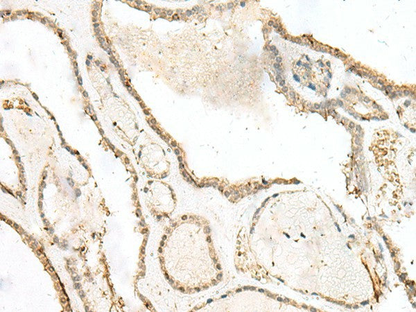 Immunohistochemistry of paraffin-embedded Human thyroid cancer tissue using LIG4 Polyclonal Antibody at dilution of 1:40(×200)