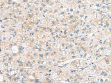 Immunohistochemistry of paraffin-embedded Human liver cancer tissue using MYL1 Polyclonal Antibody at dilution of 1:75(×200)