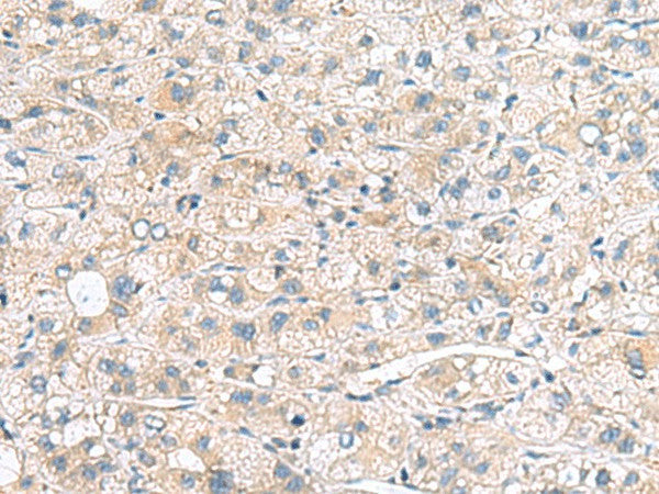 Immunohistochemistry of paraffin-embedded Human liver cancer tissue using MYL1 Polyclonal Antibody at dilution of 1:75(×200)