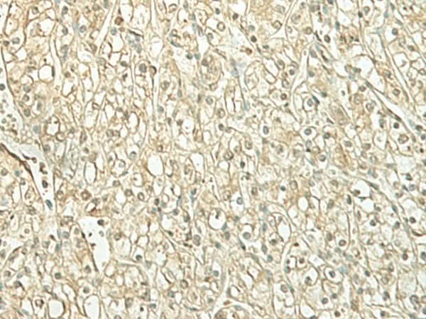 Immunohistochemistry of paraffin-embedded Human kidney cancer tissue using SPIRE1 Polyclonal Antibody at dilution of 1:60(×200)