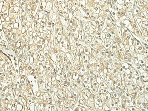 Immunohistochemistry of paraffin-embedded Human kidney cancer tissue using SPIRE1 Polyclonal Antibody at dilution of 1:60(×200)