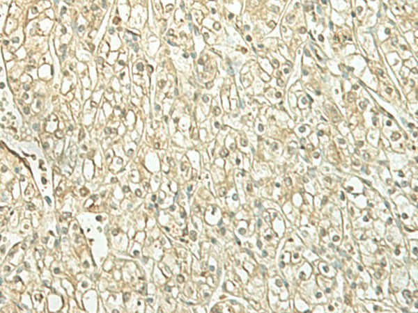Immunohistochemistry of paraffin-embedded Human kidney cancer tissue using SPIRE1 Polyclonal Antibody at dilution of 1:60(×200)