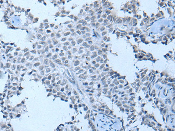 Immunohistochemistry of paraffin-embedded Human ovarian cancer tissue using ZNF703 Polyclonal Antibody at dilution of 1:55(×200)
