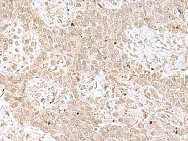 Immunohistochemistry of paraffin-embedded Human ovarian cancer tissue using RPL35 Polyclonal Antibody at dilution of 1:70(×200)