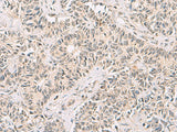 Immunohistochemistry of paraffin-embedded Human ovarian cancer tissue using RNF13 Polyclonal Antibody at dilution of 1:60(×200)