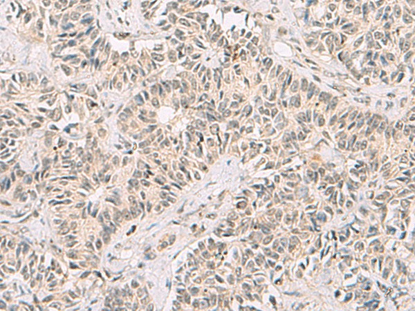 Immunohistochemistry of paraffin-embedded Human ovarian cancer tissue using RNF13 Polyclonal Antibody at dilution of 1:60(×200)