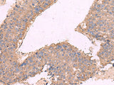Immunohistochemistry of paraffin-embedded Human liver cancer tissue using KCNN3 Polyclonal Antibody at dilution of 1:40(×200)