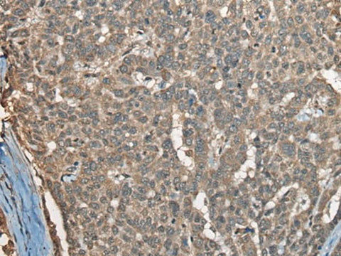 Immunohistochemistry of paraffin-embedded Human liver cancer tissue using COX7A2L Polyclonal Antibody at dilution of 1:30(×200)