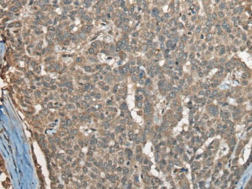 Immunohistochemistry of paraffin-embedded Human liver cancer tissue using COX7A2L Polyclonal Antibody at dilution of 1:30(×200)
