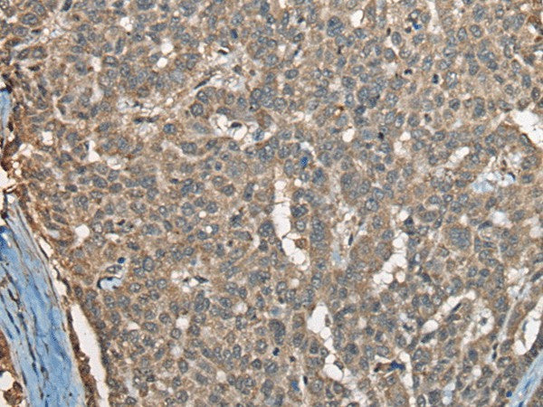 Immunohistochemistry of paraffin-embedded Human liver cancer tissue using COX7A2L Polyclonal Antibody at dilution of 1:30(×200)