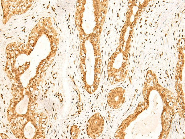 Immunohistochemistry of paraffin-embedded Human breast cancer tissue using ZNF471 Polyclonal Antibody at dilution of 1:50(×200)