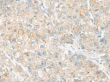 Immunohistochemistry of paraffin-embedded Human liver cancer tissue using FARP2 Polyclonal Antibody at dilution of 1:55(×200)