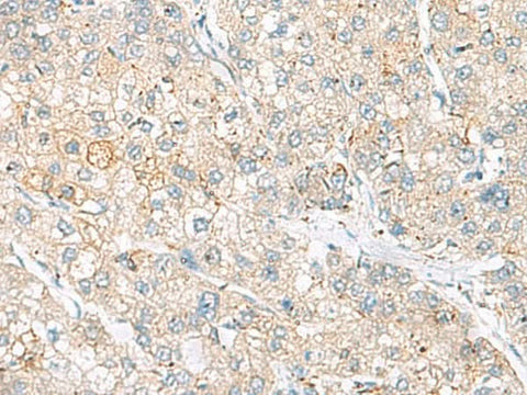 Immunohistochemistry of paraffin-embedded Human liver cancer tissue using FARP2 Polyclonal Antibody at dilution of 1:55(×200)