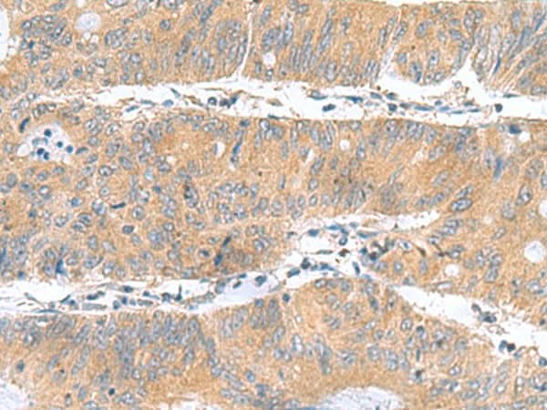 Immunohistochemistry of paraffin-embedded Human colorectal cancer tissue using DNAL1 Polyclonal Antibody at dilution of 1:50(×200)