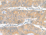 Immunohistochemistry of paraffin-embedded Human colorectal cancer tissue using DNAL1 Polyclonal Antibody at dilution of 1:50(×200)