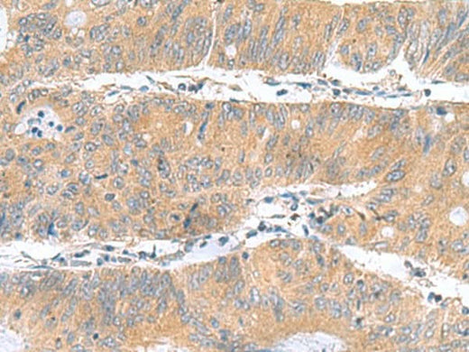 Immunohistochemistry of paraffin-embedded Human colorectal cancer tissue using DNAL1 Polyclonal Antibody at dilution of 1:50(×200)