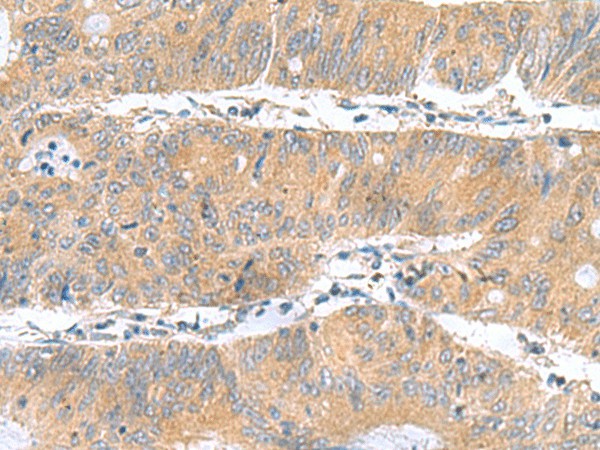 Immunohistochemistry of paraffin-embedded Human colorectal cancer tissue using DNAL1 Polyclonal Antibody at dilution of 1:50(×200)