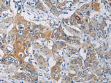 Immunohistochemistry of paraffin-embedded Human esophagus cancer tissue using KCNJ10 Polyclonal Antibody at dilution of 1:60(×200)