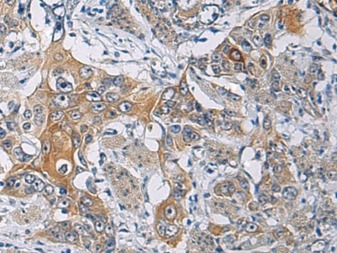 Immunohistochemistry of paraffin-embedded Human esophagus cancer tissue using KCNJ10 Polyclonal Antibody at dilution of 1:60(×200)