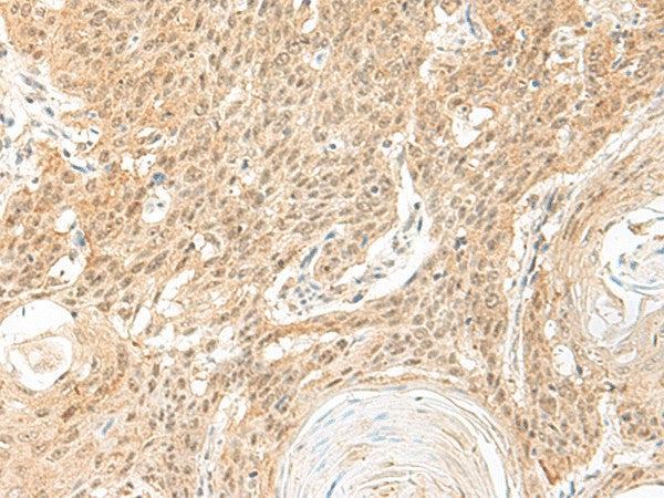 Immunohistochemistry of paraffin-embedded Human esophagus cancer tissue using BICRA Polyclonal Antibody at dilution of 1:60(×200)