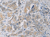Immunohistochemistry of paraffin-embedded Human esophagus cancer tissue using CYTIP Polyclonal Antibody at dilution of 1:50(×200)